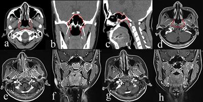 nasopharyngeal carcinoma transnasal endoscopic recurrent frontiersin mri